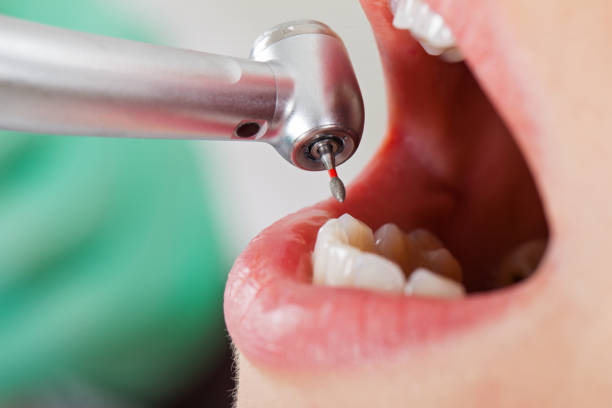 Best Urgent Care for Lost Fillings or Crowns in Rocky River, OH